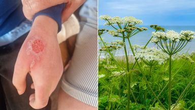 Boy, 8, 'scarred for life' after toxic giant hogweed plant causes blisters and burns