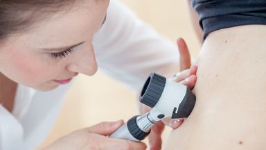 Melanoma skin cancer cases at all-time high in UK